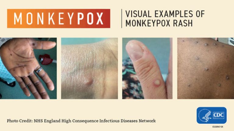 Explainer: What is monkeypox?